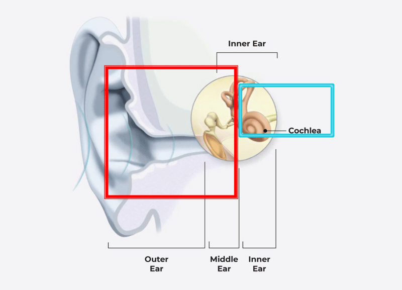 Copy of Mixed Hearing Loss (1)-1