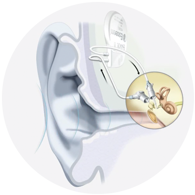Ear diagram of how the Esteem active middle ear implant works.